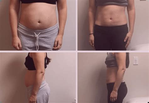 Diastasis Recti Before & After (without surgery!)