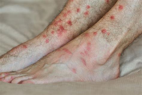 Gnat Bites : Prevention, Treatments - News Home