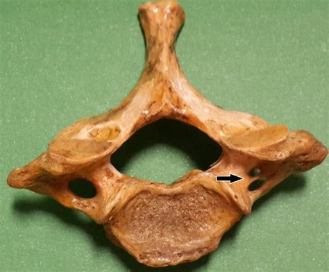 Double foramen transversarium. | Download Scientific Diagram