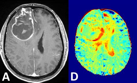 MRI contrast agents: Aiming to work without radioactivity • healthcare ...