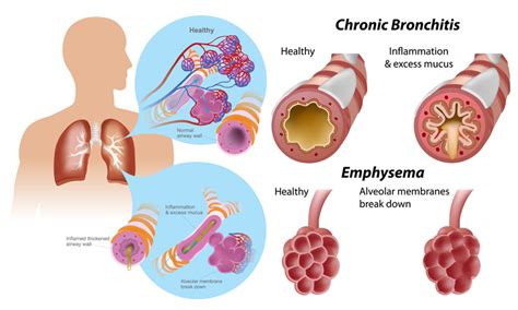 Chronic Obstructive Pulmonary Disease (COPD) - MedicoInfo