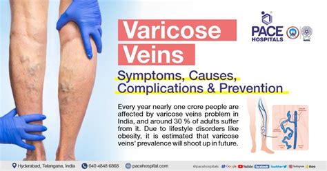 Varicose Veins – Symptoms, Causes, Complications and Treatment