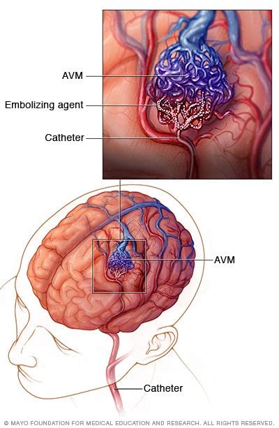 Brain AVM (arteriovenous malformation) - Diagnosis and treatment - Mayo ...