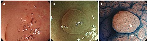 Colon Polyps Size