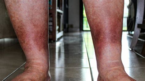 Venous Insufficiency: Early Signs, Causes, Treatment, and More