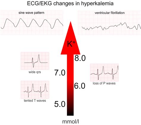 5 ECG Changes of Hyperkalemia you Need to Know – Acadoodle – Medium