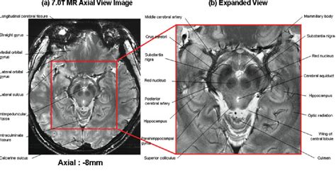 Figure 2 from New brain atlas - Mapping the human brain in vivo with 7. ...