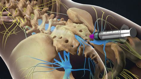 Lumbar caudal epidural steroid injection Southlake, Texas – South Lake ...