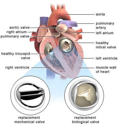 Mitral Valve Replacement Positioning Diagram