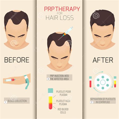 PRP Therapy For Hair Loss