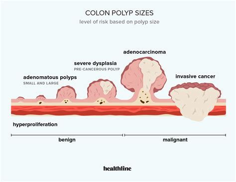 Sessile Serrated Polyps Cancer Risk And Appropriate