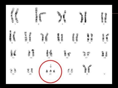 Chromosomal abnormalities