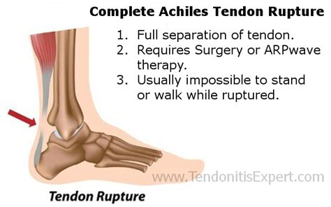 Achilles Tendon Rupture, Helpful Ruptured Achilles Tendon Information