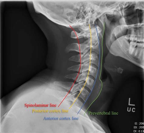 Healthy Cervical Spine Xray