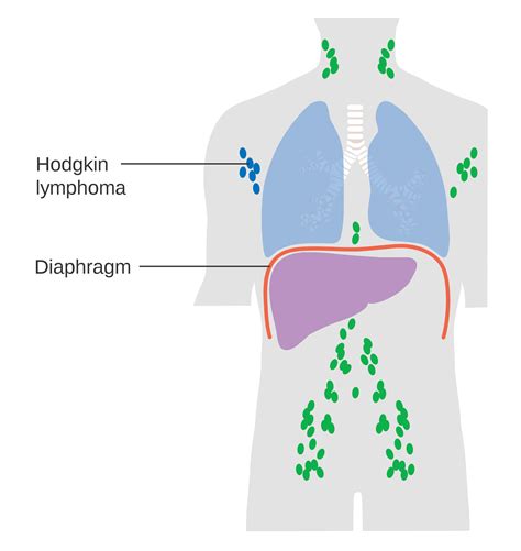 Stages of Adult Hodgkin Lymphoma - StoryMD