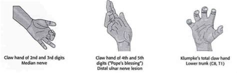 Ape Hand Median Nerve Palsy