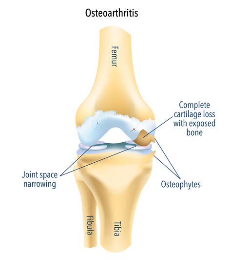 Knee Osteoarthritis Treatment & Surgery | Osteoarthritis Knee Replacement