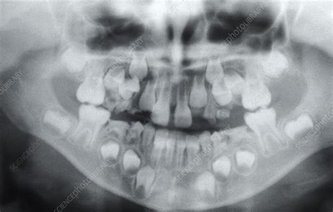 Baby Teeth Panoramic Xray | linkskadel