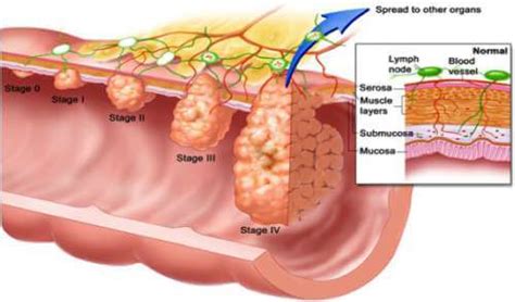 Colon Polyps: Learn The Facts Here - Step To Health