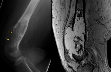 Chondrosarcoma - Radiology at St. Vincent's University Hospital