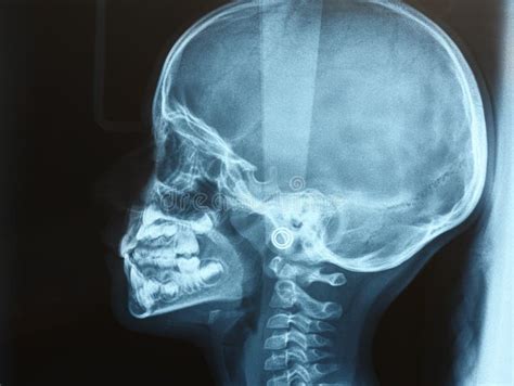 Xray of the Head of a Child or Kid Side View Stock Image - Image of ...