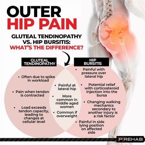 Gluteal tendinopathy gtps symptoms and diagnosis trochanteric bursitis ...