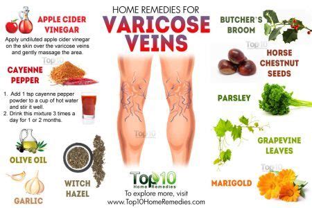 Home Remedies For Varicose Veins