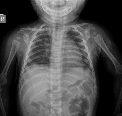 Child Chest Xray Image Stock Photo - Download Image Now - iStock