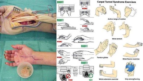 Carpal Tunnel Syndrome Exercises Active range of motion Wrist stretch ...