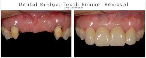 Resin Bonded Bridge: Minimally Invasive Option for Tooth Replacement ...