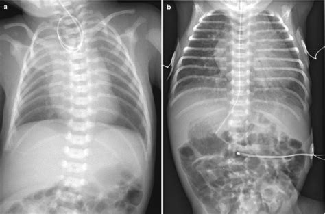 Neonatal Chest Imaging | Radiology Key