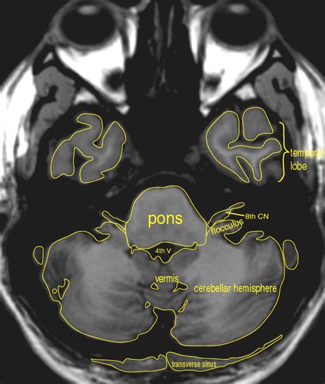 MRI Atlas: Brain (Axial) - Scan 2 - Labeled (Enlarged) | Eccles Health ...