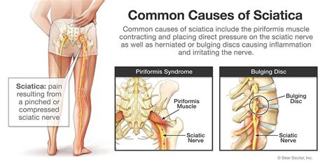 Sciatica | Spine Surgeon In The Woodlands, TX | Houston Advanced Spine ...