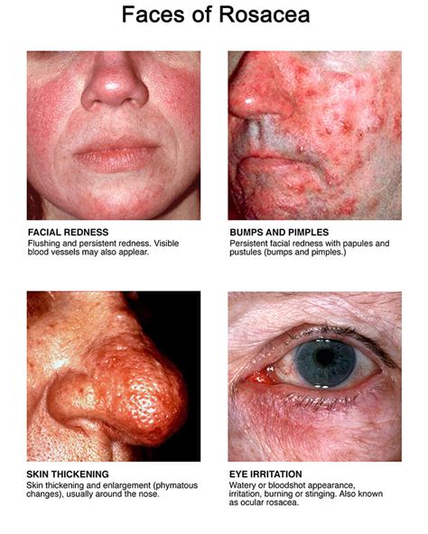 All About Rosacea: Signs & Symptoms and Treatment (2022)