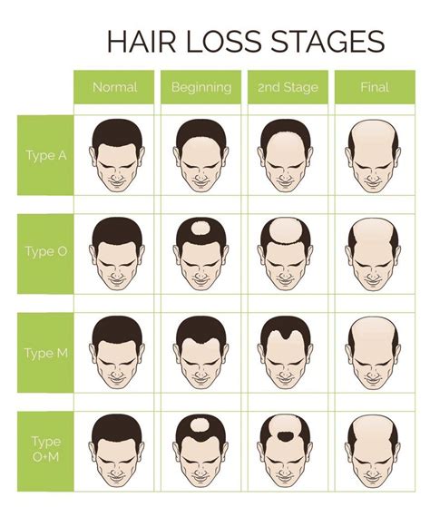 Hair Loss Stages And Types Of Male Hair Loss Male Pattern Baldness Head ...