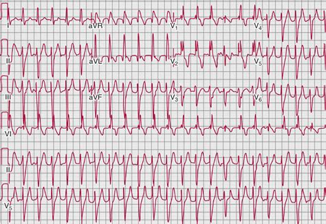 Images Of Ventricular Tachycardia