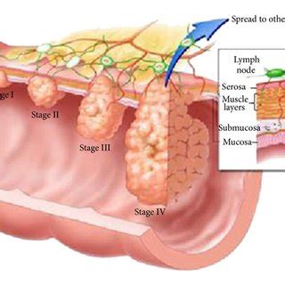 (PDF) Precancerous Lesions in Colorectal Cancer