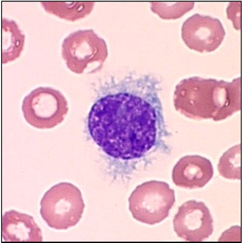 Hairy Cell Leukemia (HCL) - Oncology - Medbullets Step 1