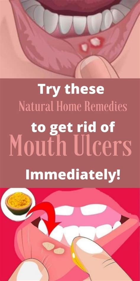 Treating Mouth Sores: Tips and Remedies - Rijal's Blog