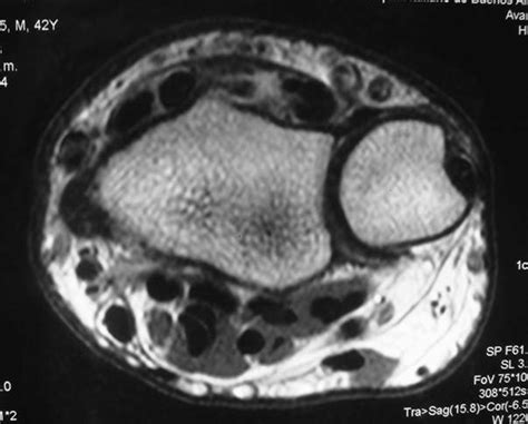 MRI showing the tenosynovitis of the extensor pollicis longus ...