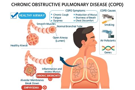 COPD: Symptoms, Causes, Risk, Diagnosis and Treatment