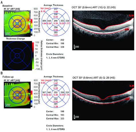 Thickness image and gray scale map of retina and macular layer obtained ...