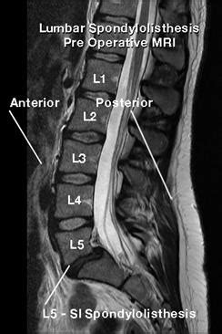 Lumbar Spondylolisthesis | My Doctor Online