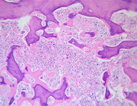 Myelofibrosis associated osteomyelosclerosis - 2.