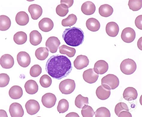 Lymphoblasts - 2.