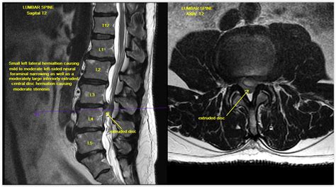 Lumbar Spine Mri Herniation