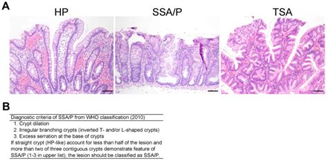 Hyperplastic Polyp