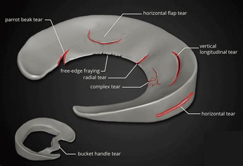 The Complete Guide to a Meniscus Tear | Kinetic Labs