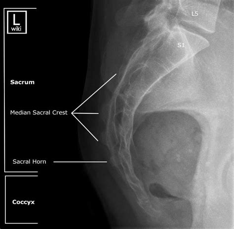 Sacrum Radiographic Anatomy - wikiRadiography | Radiology, Diagnostic ...