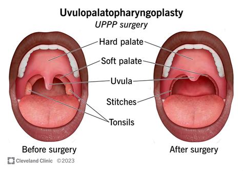 Uvulopalatopharyngoplasty (UPPP Surgery)